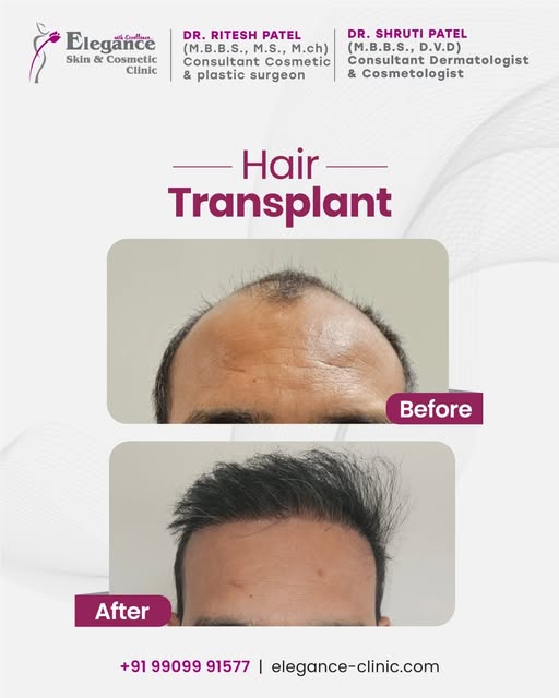 Restore your confidence with natural-looking hair transformation results. ✨ Expert hair transplant s