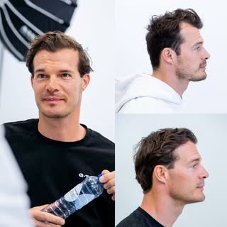 Het definitieve resultaat van de FUE haartransplantatie behandeling is na een jaar te zien. Dat is o