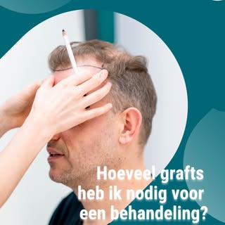 Het aantal benodigde grafts voor een haartransplantatie behandeling hangt af van twee factoren. Dit 