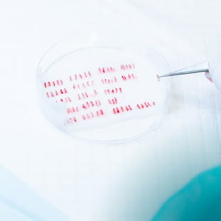 Het sorteren van grafts (groepjes haarzakjes) is heel belangrijk. Na het uithalen van de grafts uit 