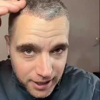 Bart van Moorsel, bekend van Puberbreintv, heeft een semi haarsparende behandeling van 1.250 grafts 