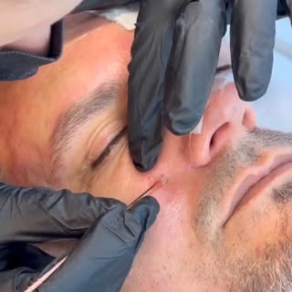 No nosso protocolo de crescimento de barba, o primeiro passo é sempre a limpeza de pele.
Isso remove