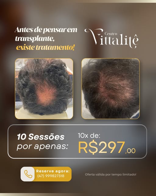 Antes de pensar em transplante, vale entender o que ainda pode ser tratado.

A queda, o afinamento e