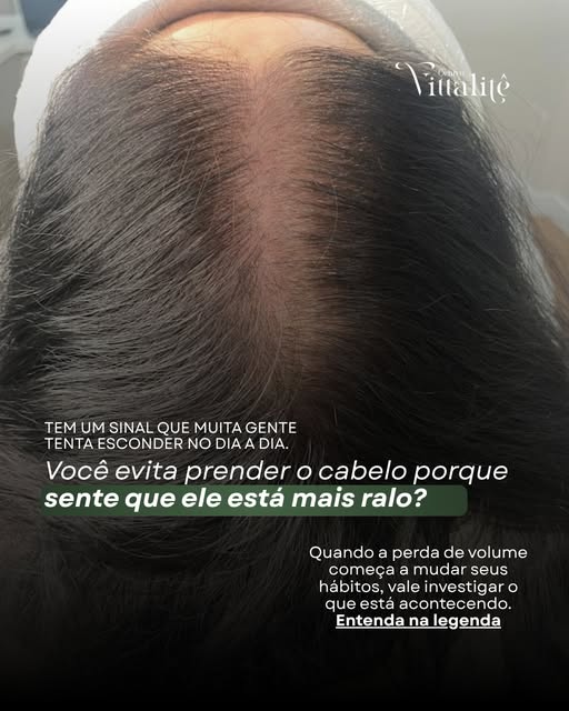 Se você começou a evitar prender o cabelo porque sente que o couro cabeludo está aparecendo mais, ta
