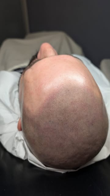 2 months healed SMP
 #scalpqueen #smplondon #smp #scalpmicropigmentation #smpclinic