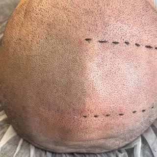 Masterclass with Nigel 🧡

This time we worked on a real case with a previous hair transplant, which