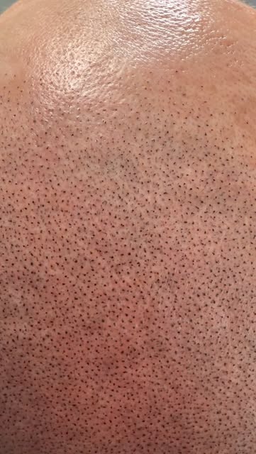 During the process ☺️ love my work 🫶🏻
#smplondon #smp #scalpmicropigmentation #smpclinic #scalpque