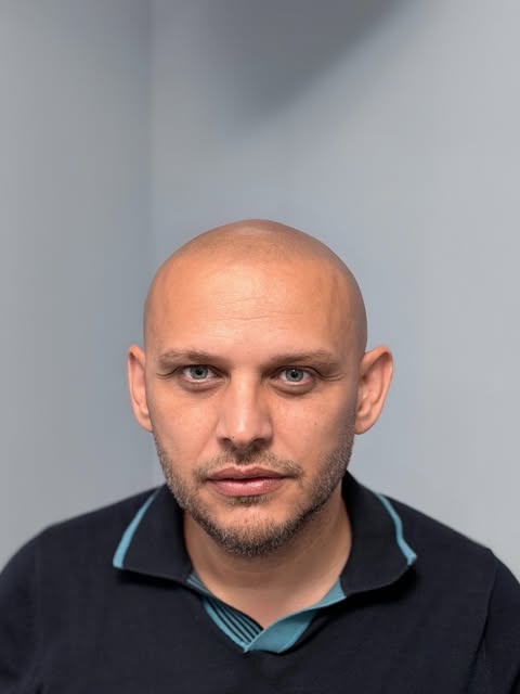 From bald to a natural-looking hairline.

SMP is not about making you look like you have a full head