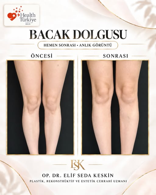 İnce bir dokunuş, daha dengeli bir bacak kontürü. ✨

Bacak dolgusu sonrası anlık görünüm… Nihai sonu