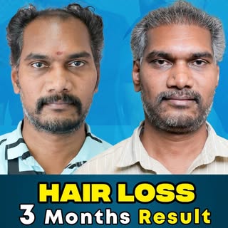 💥3 Months Result ❤️‍🔥 GET BACK YOUR CONFIDENCE
THROUGH SUKIRA's BEST TREATMENT 💥

வழுக்கை தலை இனி