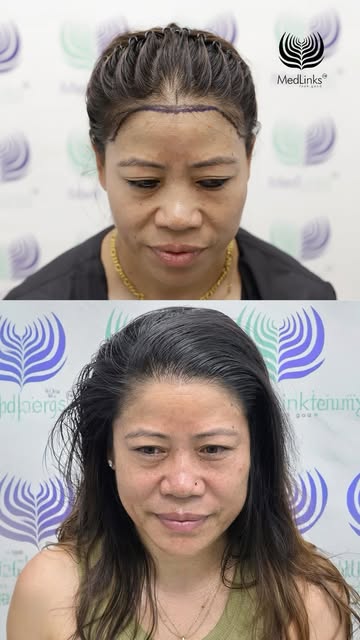 Why should men have all the fun..
Now women can also do Hair Transplants for receding hairlines

Fro