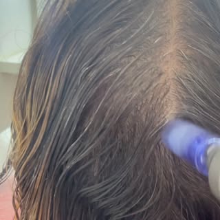 Microagulhamento capilar funciona para queda de cabelo?

Pode ajudar em alguns casos, mas o mais imp