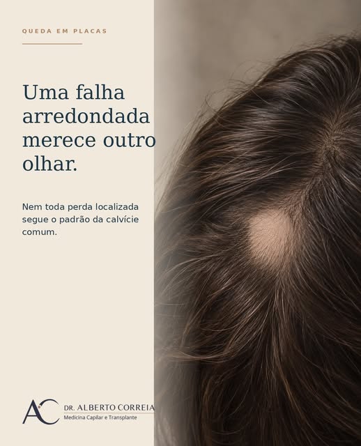 Uma falha localizada nem sempre segue o padrão da calvície comum.

Na alopecia areata, a perda pode 