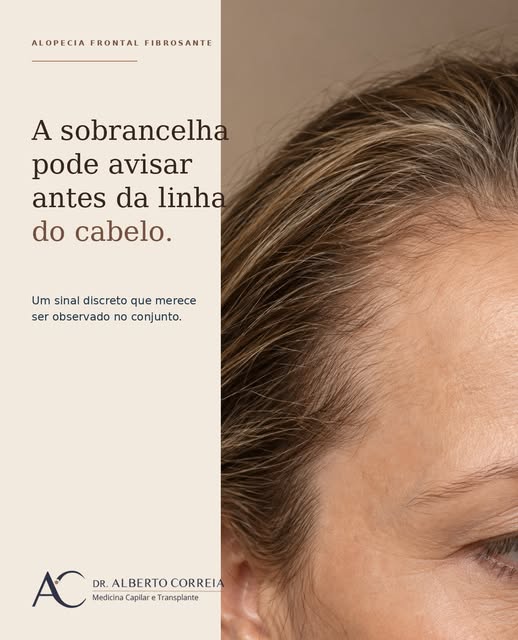 A sobrancelha pode revelar sinais antes mesmo da linha do cabelo.

Na alopecia frontal fibrosante, o