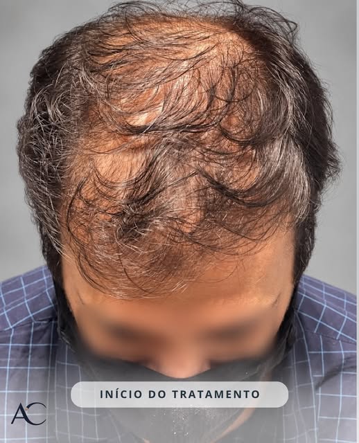 Do início do tratamento à evolução atual.

Este resultado foi alcançado sem transplante capilar, por