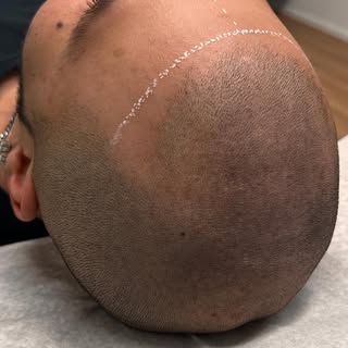 Strakkere haarlijn met MHP. #hairpigmentation #mhp #microhairpigmentation #hairtattoo