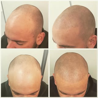 Nog 1 sessie te gaan voor nog meer dichtheid. Nu al een groot verschil. #aliviopigment #hairtattoo #