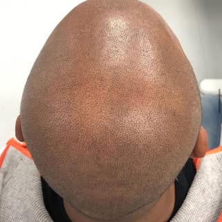1st session finished #scalpmicropigmentation #scalptattoo #microhairpigmentation #pmu #tattoo #micro