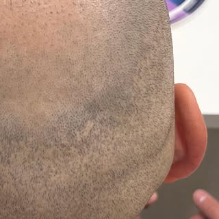 Failed hairtransplantation..now MHP shaven look. Redness will disappear after a day #micropigmentati