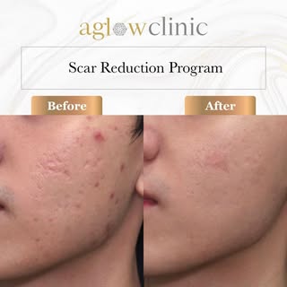 Make the difference you deserve on your scar!✨

Now with the help of our ScarAwayByDoctor, Malaysia'