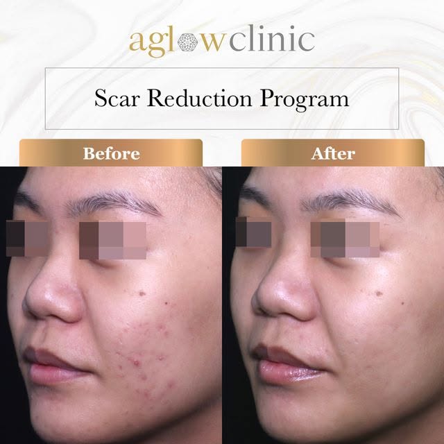 Red marks on your skin😮? That’s actually the best time to treat them! 

Did you know? The best time