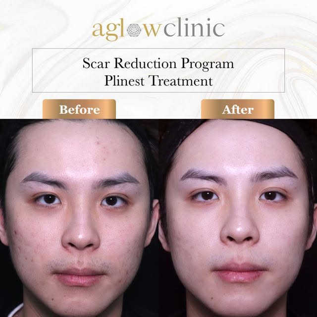 Spot the difference! Smoother, clearer skin in the making🌟

☑️ Core Treatment: ScarAway™ x JuveCell