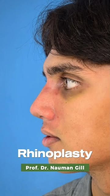 Revision Rhinoplasty for severely deviated nose, hump deformity and asymmetric nostrils.

www.drnaum