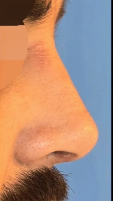 Severe nasal deviation with a depressed bridge — treated with septorhinoplasty and nasal augmentatio