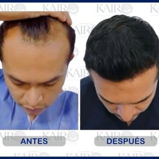 Antes y después de procedimiento de injerto capilar

El presente contenido tiene fines exclusivament