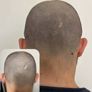 Skalp pigmentering ärr kamouflage utfördes på en kund som hade gjort en FUE hårtransplantation.🙏🏼�