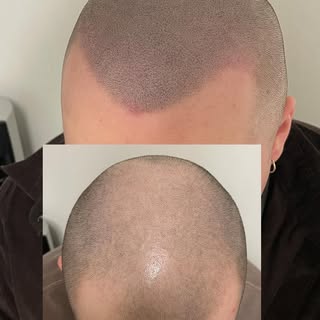 Magiskt vackert resultat på vår fina kund 🫶🏽💯🙏🏼👑.
Slut resultatet!
Rodnaden lägger sig efter n