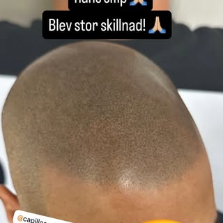 Kunden fick en smp behandling hos en amatör smp studio i Stockholm där resultatet blev katastrof. Ha