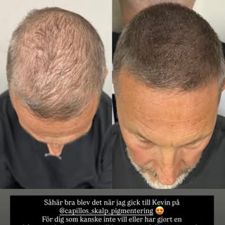 Tack Martin Björk för förtroendet 🙏🏼 

Här ser ni före och efter resultatet av Skalp pigmentering 