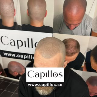 Snyggt slutresultat på vår fina kund 🙏🏼💯🫶🏽😍

@capillos_skalp_pigmentering 
www.capillos.se 

.