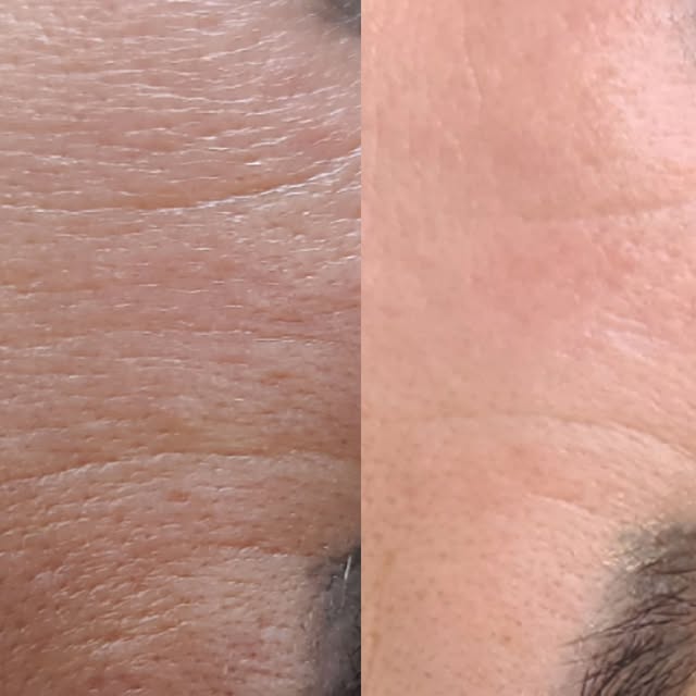 Can you believe the difference just two sessions of microneedling makes?! Scroll through these recen