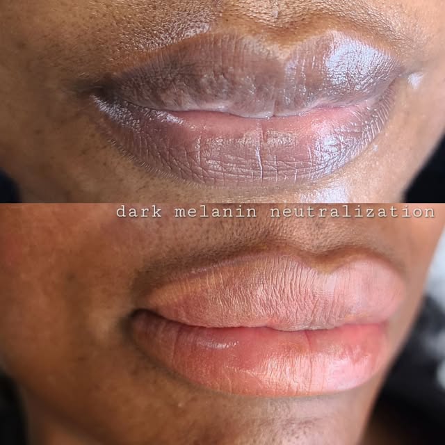 Loving the results from right after this #lipneutralization session 🔥

Lip neutralization is a cust
