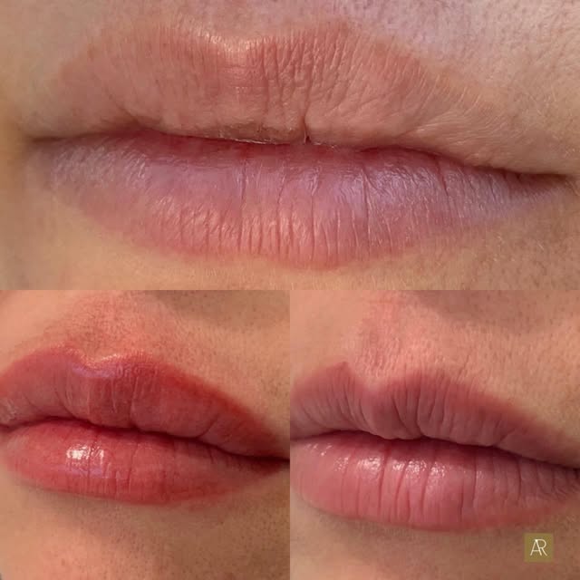 Um novo contorno, mais equilíbrio e naturalidade✨

Neste resultado de micropigmentação labial, acomp