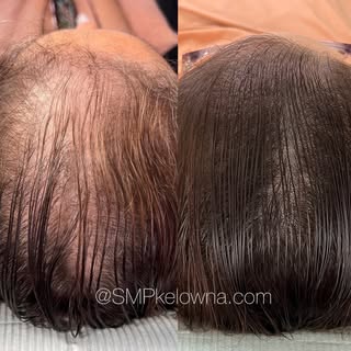 Scalp micro pigmentation 👌💝
Boosting confidence levels to 💯since 2015