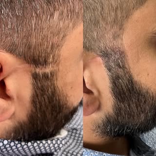 👌Beard Scar Camouflage @smpkelowna