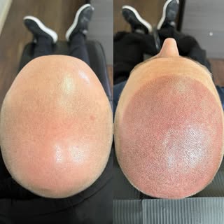 Today in the studio.
Changing lives over here with scalp micro pigmentation.
Smp is a life-changing 