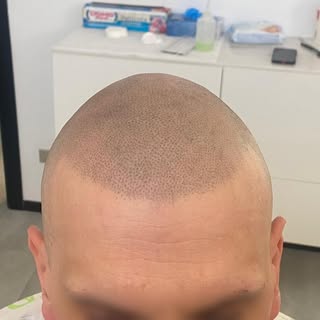 Ecco il prima e il dopo di un trattamento di tricopigmentazione appena realizzato. Può essere una bu