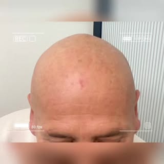 Tricopigmentazione dal 2015#tricopigmentazione #hairstyle #menshealth #tatuaggio