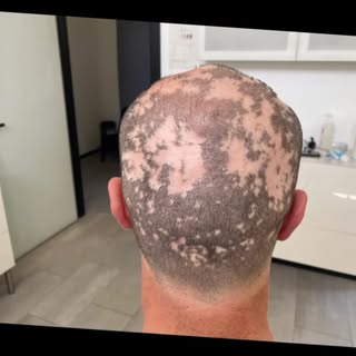 Tricopigmentazione su alopecia areata#tricopigmentazione #alopecia#hairtattoo