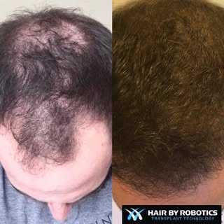 At Hair By Robotics, providing exceptional patient care is our number one priority. We take pride in