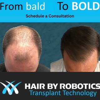 Follicular Unit Extraction, or FUE, is a minimally invasive hair transplant method that removes indi