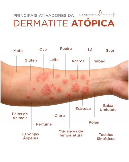 Coceira intensa, vermelhidão e pele ressecada podem ser sinais de dermatite atópica.
Essa condição i