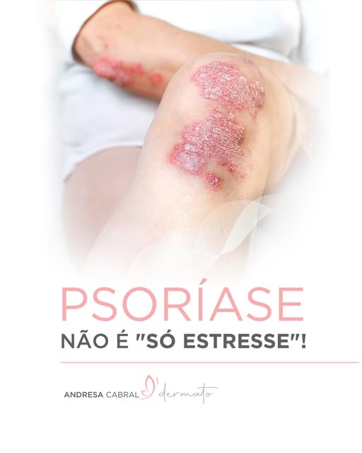 "Você só precisa se acalmar que isso some." 🙄

Quem tem psoríase certamente já ouviu essa frase. Em