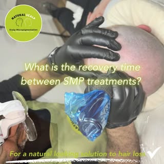 #ScalpMicropigmentation #hairlosssolutions #cardiff #southwalesbusiness