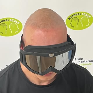 Permanent hair loss solution @ Natural Scalp Cardiff