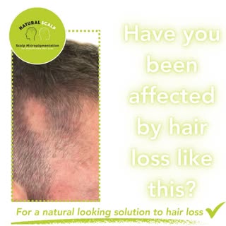Is hair loss hurting your confidence? #hairlosshelp #hairlosscommunity #southwales